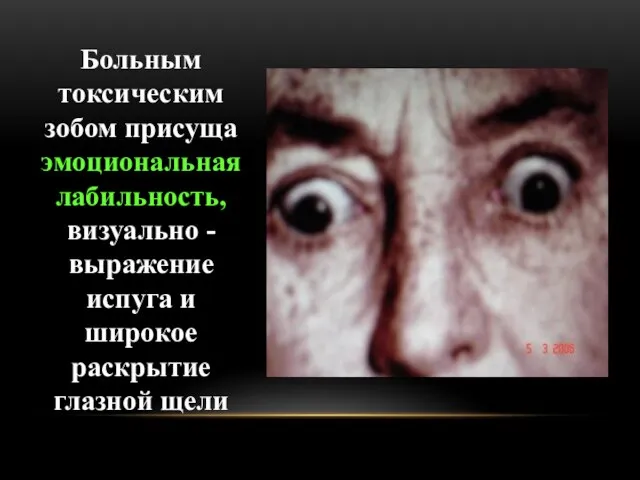 Больным токсическим зобом присуща эмоциональная лабильность, визуально - выражение испуга и широкое раскрытие глазной щели