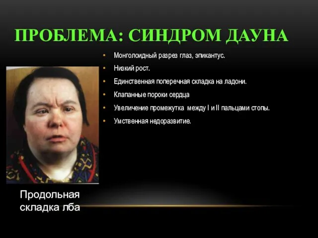 ПРОБЛЕМА: СИНДРОМ ДАУНА Монголоидный разрез глаз, эпикантус. Низкий рост. Единственная поперечная складка