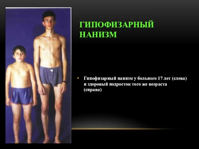 ГИПОФИЗАРНЫЙ НАНИЗМ Гипофизарный нанизм у больного 17 лет (слева) и здоровый подросток того же возраста (справа)