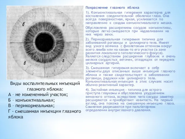 Покраснение глазного яблока 1). Конъюнктивальная гиперемия характерна для воспаления соединительной оболочки глаза.