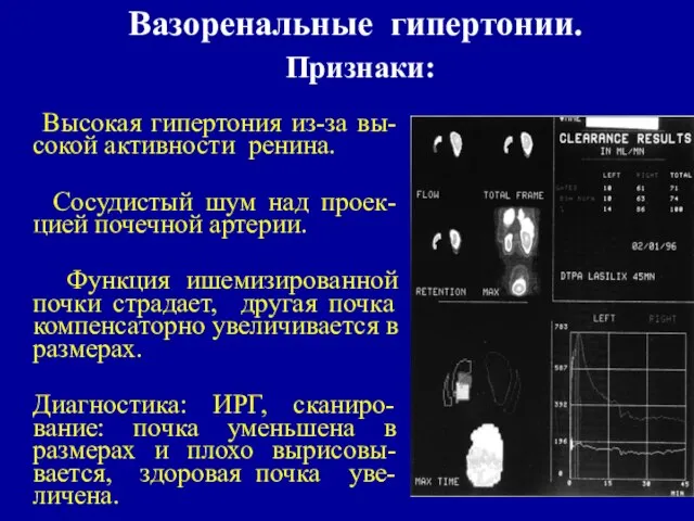 Вазоренальные гипертонии. Признаки: Высокая гипертония из-за вы-сокой активности ренина. Сосудистый шум над