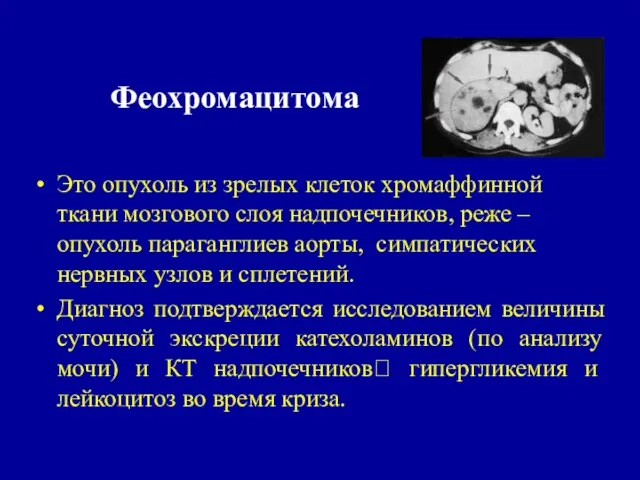 Феохромацитома Это опухоль из зрелых клеток хромаффинной ткани мозгового слоя надпочечников, реже