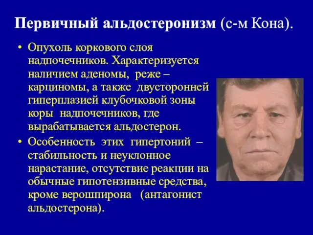 Первичный альдостеронизм (с-м Кона). Опухоль коркового слоя надпочечников. Характеризуется наличием аденомы, реже