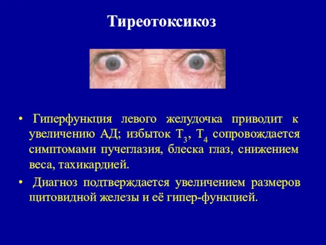 Тиреотоксикоз Гиперфункция левого желудочка приводит к увеличению АД; избыток Т3, Т4 сопровождается