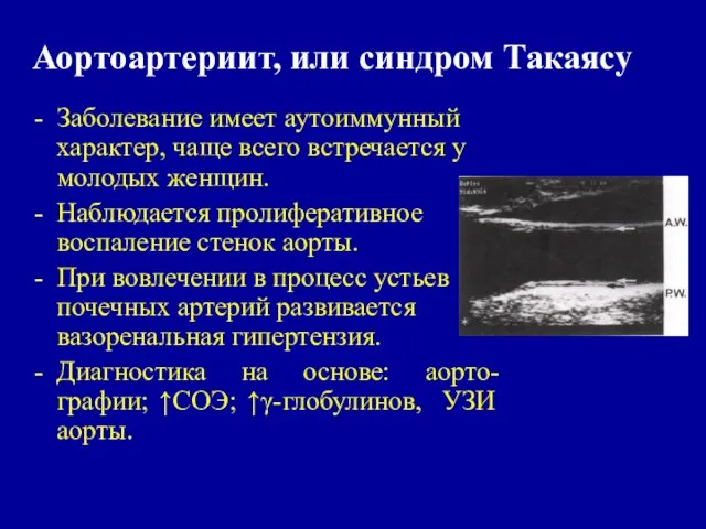 Аортоартериит, или синдром Такаясу Заболевание имеет аутоиммунный характер, чаще всего встречается у