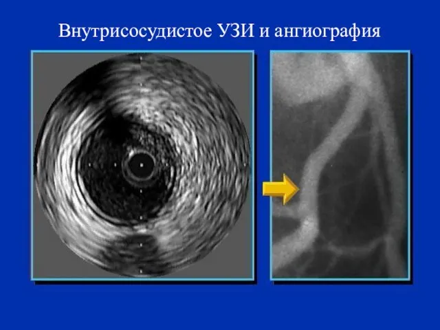 Внутрисосудистое УЗИ и ангиография