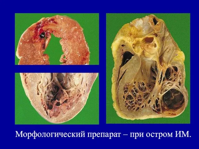 Морфологический препарат – при остром ИМ.