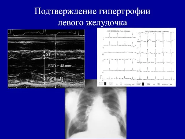 Подтверждение гипертрофии левого желудочка