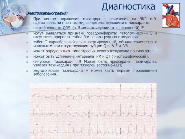 Диагностика Электрокардиография: При легком поражении миокарда – изменения на ЭКГ м.б. единственными