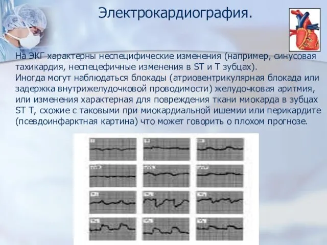 Электрокардиография. На ЭКГ характерны неспецифические изменения (например, синусовая тахикардия, неспецефичные изменения в