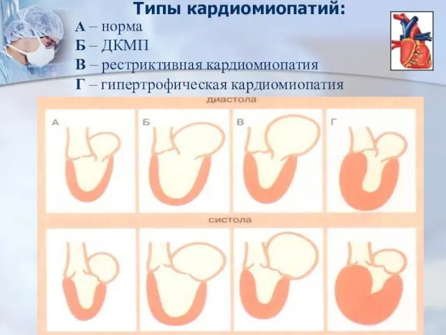 Типы кардиомиопатий: А – норма Б – ДКМП В – рестриктивная кардиомиопатия Г – гипертрофическая кардиомиопатия