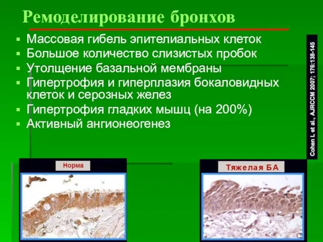 Ремоделирование бронхов Массовая гибель эпителиальных клеток Большое количество слизистых пробок Утолщение базальной