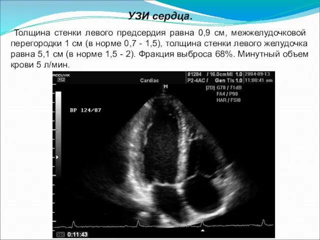 УЗИ сердца. Толщина стенки левого предсердия равна 0,9 см, межжелудочковой перегородки 1
