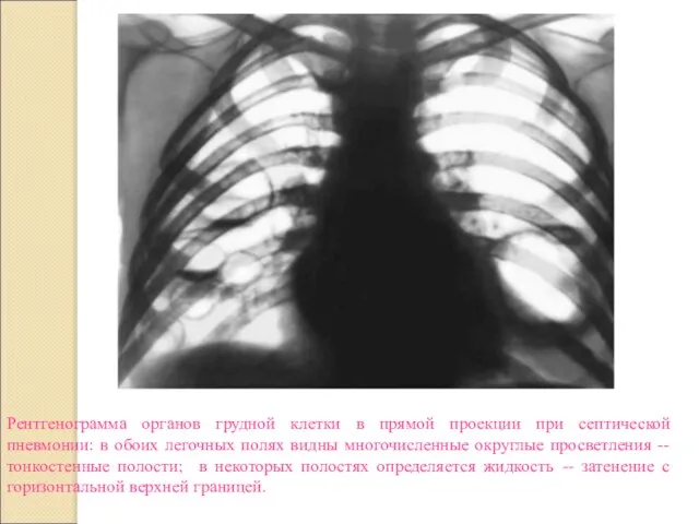 Рентгенограмма органов грудной клетки в прямой проекции при септической пневмонии: в обоих