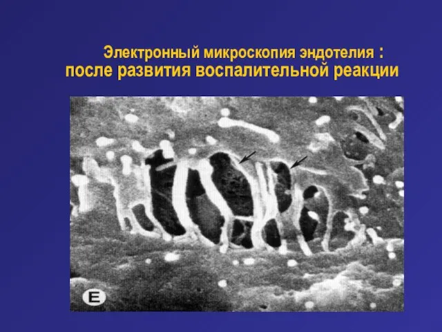 Электронный микроскопия эндотелия : после развития воспалительной реакции