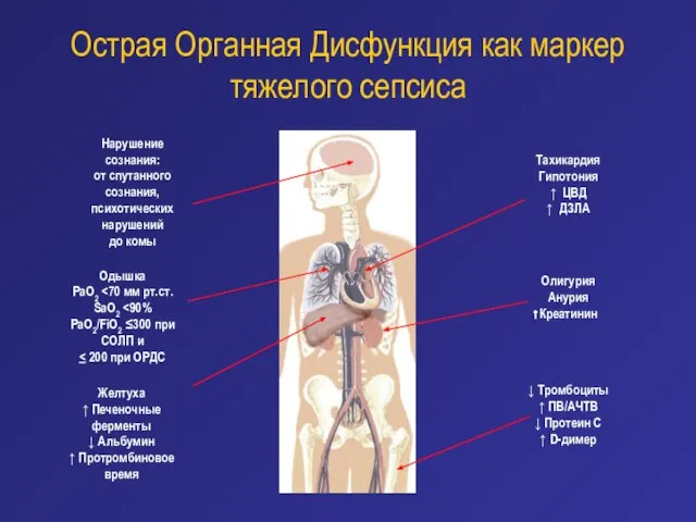 Острая Органная Дисфункция как маркер тяжелого сепсиса Тахикардия Гипотония ↑ ЦВД ↑