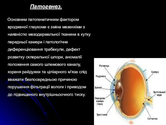Патогенез. Основним патогенетичним фактором вродженої глаукоми є зміна мезенхіми з наявністю мезодермальної