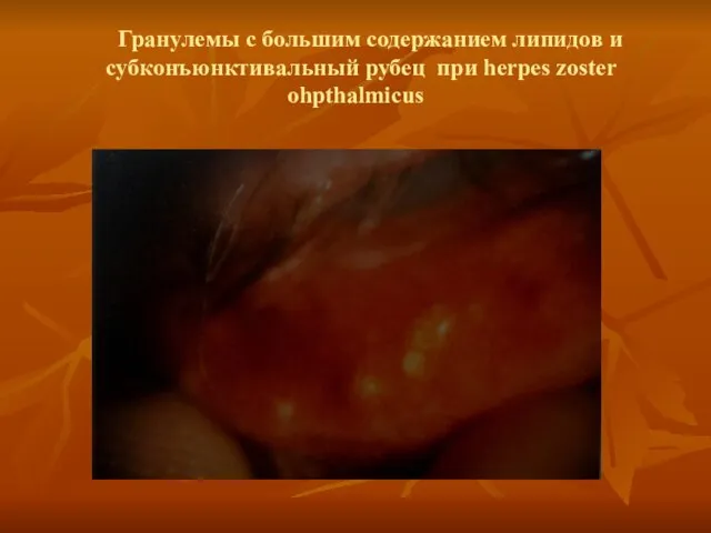 Гранулемы с большим содержанием липидов и субконъюнктивальный рубец при herpes zoster ohpthalmicus