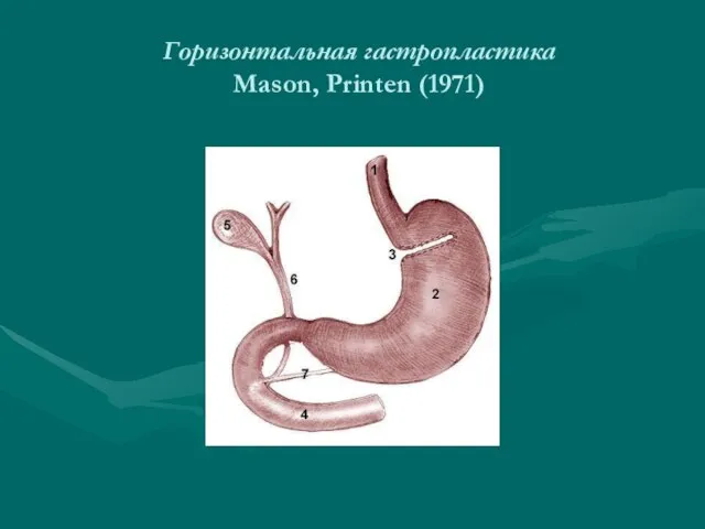 Горизонтальная гастропластика Mason, Printen (1971)