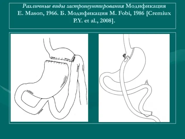 Различные виды гастрошунтирования Модификация Е. Mason, 1966. Б. Модификация М. Fobi, 1986