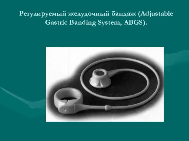 Регулируемый желудочный бандаж (Аdjustable Gastric Banding System, ABGS).