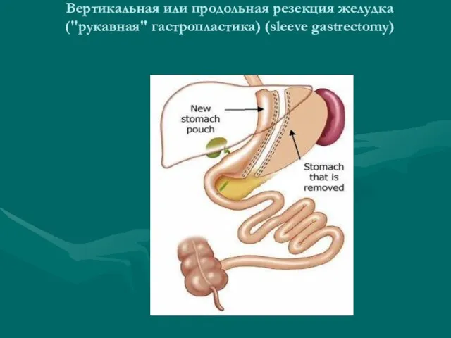Вертикальная или продольная резекция желудка ("рукавная" гастропластика) (sleeve gastrectomy)