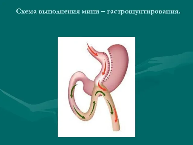 Схема выполнения мини – гастрошунтирования.