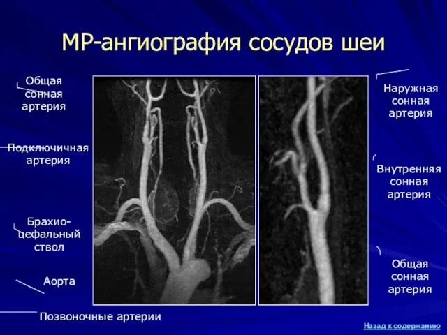 МР-ангиография сосудов шеи Аорта Брахио-цефальный ствол Общая сонная артерия Подключичная артерия Позвоночные