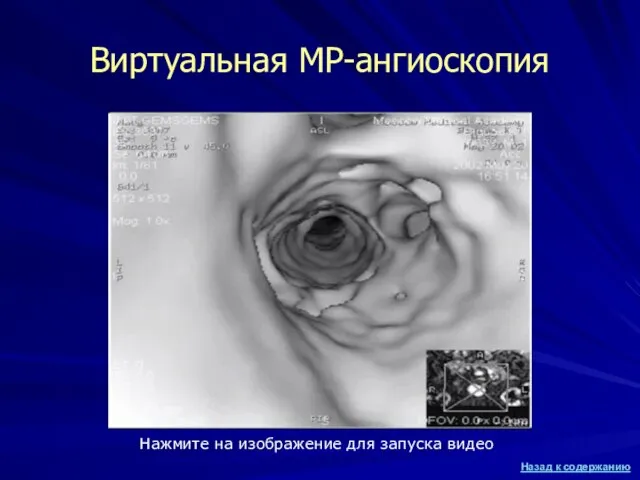 Виртуальная МР-ангиоскопия Нажмите на изображение для запуска видео