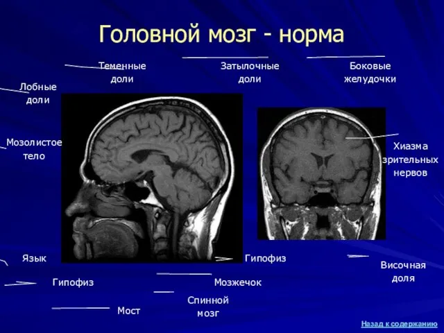 Головной мозг - норма Язык Спинной мозг Мозжечок Мост Гипофиз Лобные доли