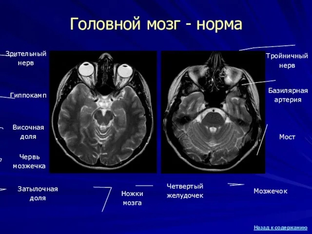 Головной мозг - норма Затылочная доля Червь мозжечка Ножки мозга Гиппокамп Зрительный