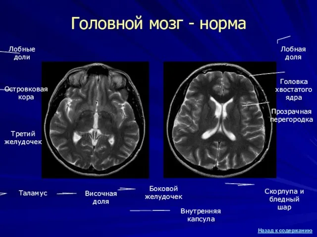 Головной мозг - норма Лобные доли Третий желудочек Островковая кора Таламус Височная