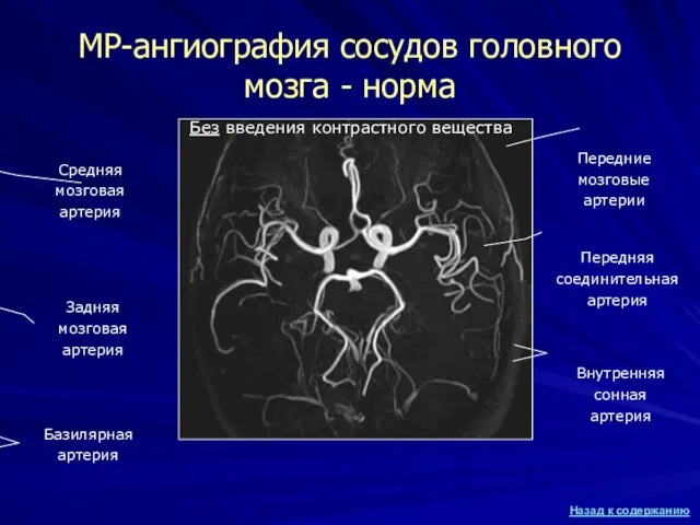 МР-ангиография сосудов головного мозга - норма Без введения контрастного вещества Средняя мозговая