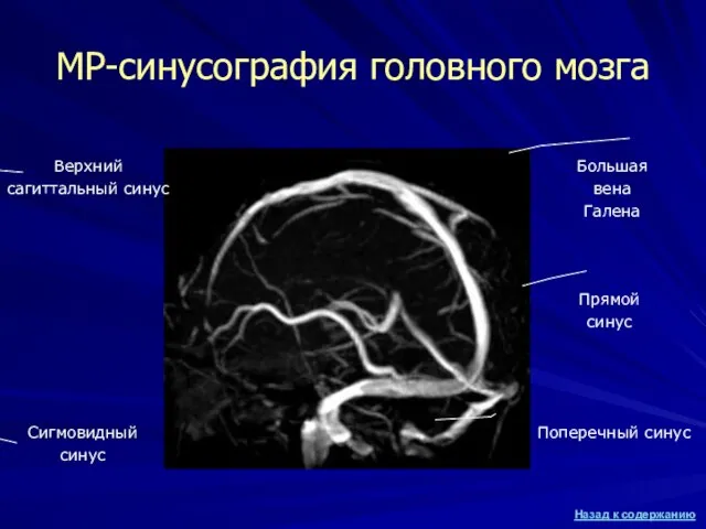 МР-синусография головного мозга Верхний сагиттальный синус Сигмовидный синус Поперечный синус Большая вена Галена Прямой синус