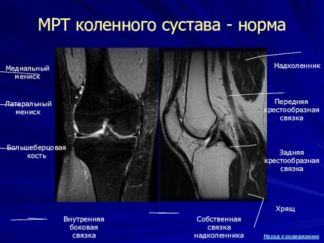 МРТ коленного сустава - норма Большеберцовая кость Задняя крестообразная связка Передняя крестообразная