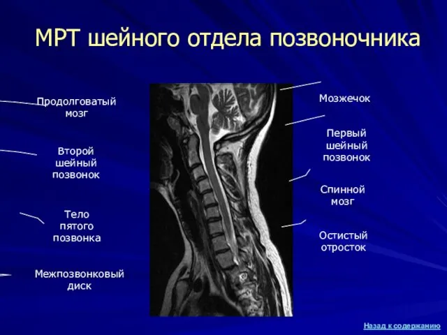 МРТ шейного отдела позвоночника Продолговатый мозг Спинной мозг Второй шейный позвонок Межпозвонковый