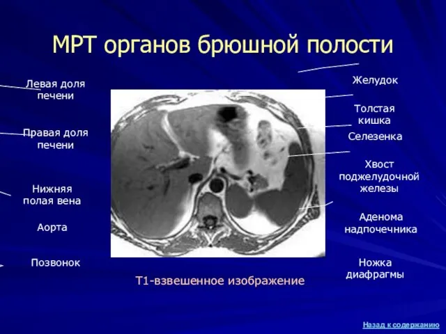 МРТ органов брюшной полости Т1-взвешенное изображение Правая доля печени Левая доля печени