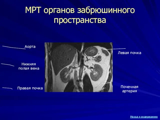 МРТ органов забрюшинного пространства Правая почка Левая почка Аорта Почечная артерия Нижняя полая вена