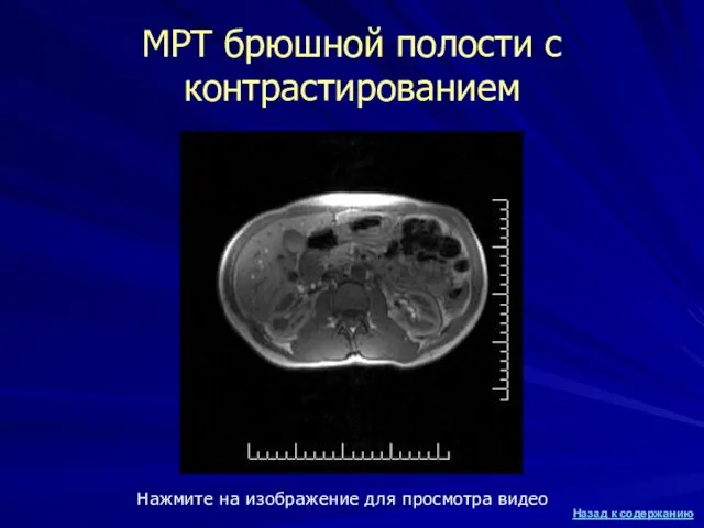 МРТ брюшной полости с контрастированием Нажмите на изображение для просмотра видео