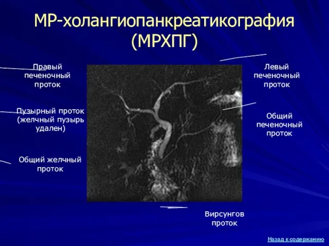 МР-холангиопанкреатикография (МРХПГ) Общий желчный проток Вирсунгов проток Пузырный проток (желчный пузырь удален)