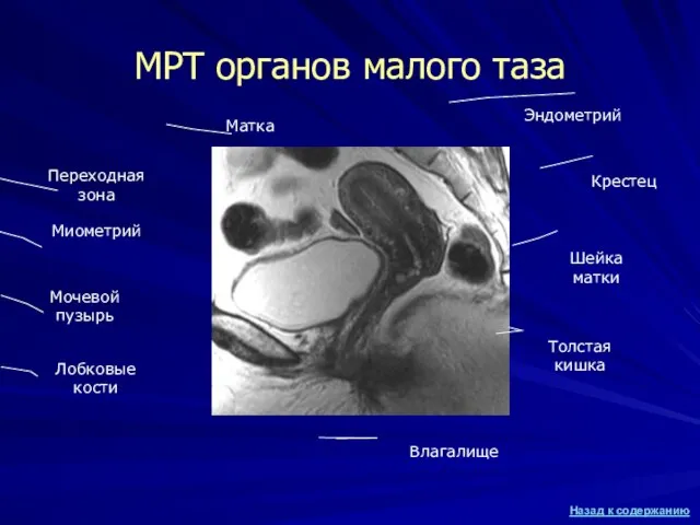 МРТ органов малого таза Мочевой пузырь Матка Лобковые кости Толстая кишка Крестец