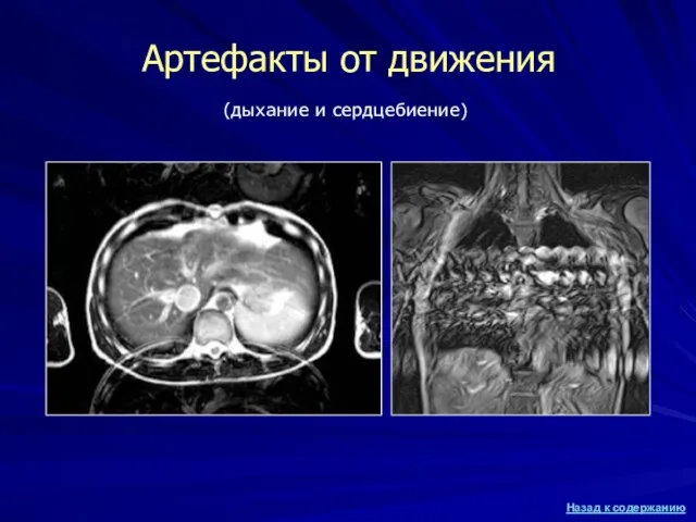 Артефакты от движения (дыхание и сердцебиение)