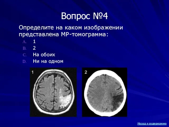 Вопрос №4 Определите на каком изображении представлена МР-томограмма: 1 2 На обоих
