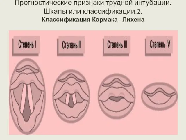 Прогностические признаки трудной интубации. Шкалы или классификации.2. Классификация Кормака - Лихена