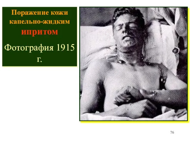 Поражение кожи капельно-жидким ипритом Фотография 1915 г.