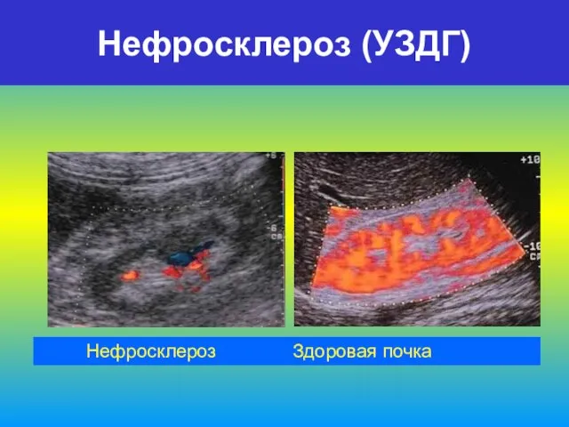 Нефросклероз (УЗДГ) Нефросклероз Здоровая почка