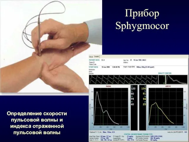 Прибор Sphygmocor Определение скорости пульсовой волны и индекса отраженной пульсовой волны