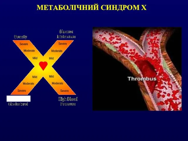 МЕТАБОЛІЧНИЙ СИНДРОМ Х