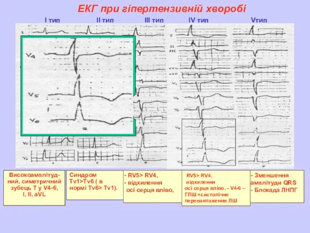 ЕКГ при гіпертензивній хворобі І тип ІІ тип ІІІ тип IV тип