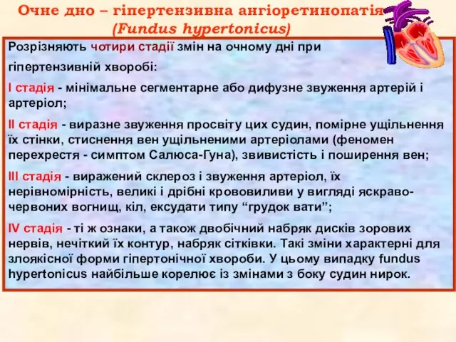 Очне дно – гіпертензивна ангіоретинопатія (Fundus hypertonicus) Розрізняють чотири стадії змін на